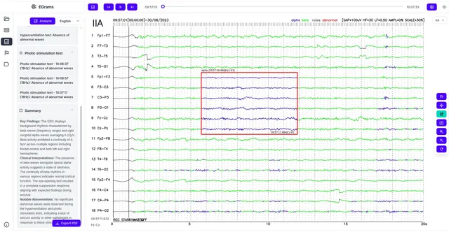 EEG CDAs